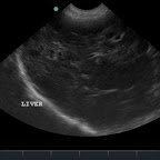 Hepatic Lymphoma diagnosed by ultrasound-guided sampling