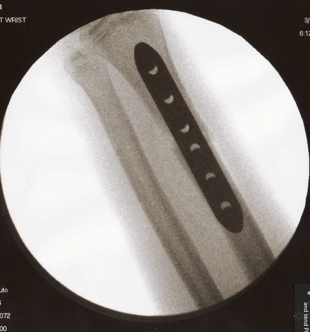 [wrist after2[5].jpg]