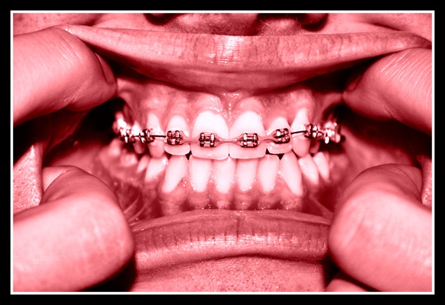 [Braces_by_solo_talent[4].jpg]