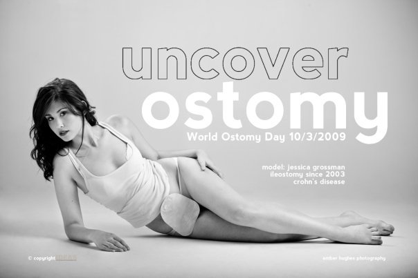 [uncover ostomy[5].jpg]