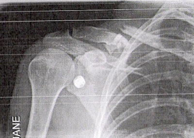 Broken COLLAR BONE Recovery MTB Mountain Bike Training Plan - LW 