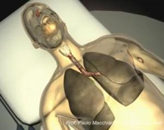 Still image from a video showing a visualization of the transplantation operation using the new trachea. (Credit: Paolo Macchiarini)