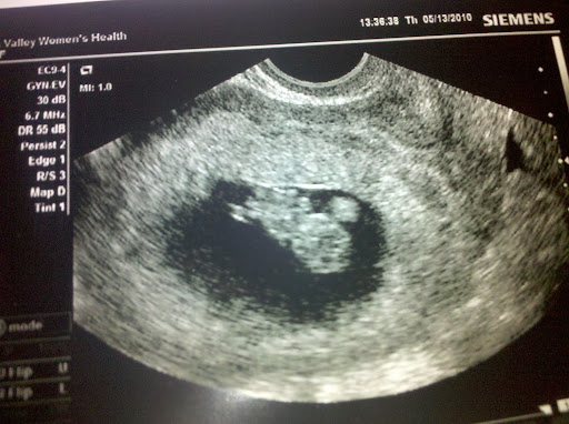 Lone Sunflower 9 Week Baby Ultrasound