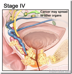 Prostate Cancer Stage IV