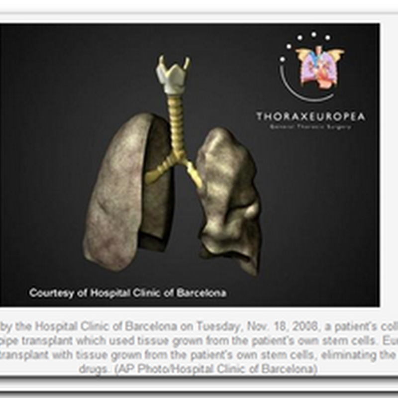 Doctors transplant windpipe with stem cells