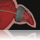 Watchman device for atrial fibrillation