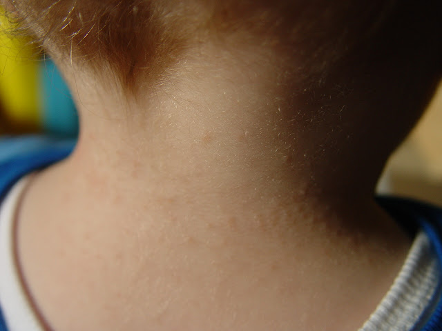 Rash On Back Of Neck BabyCenter