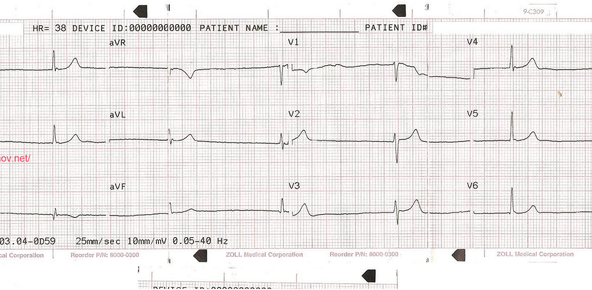 Брадикардия у спортсменов