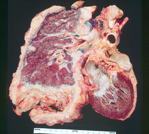 Pleural Thickening Icd