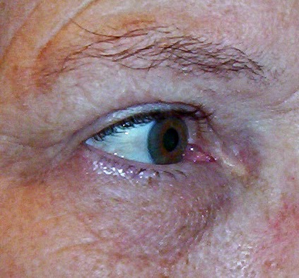 Discoloration Around Eyes. discoloration around eye