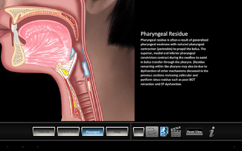 Swallowing Residue Screenshots 2