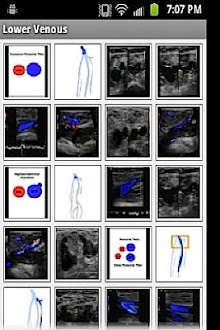 iSonographer Venous R/O DVT