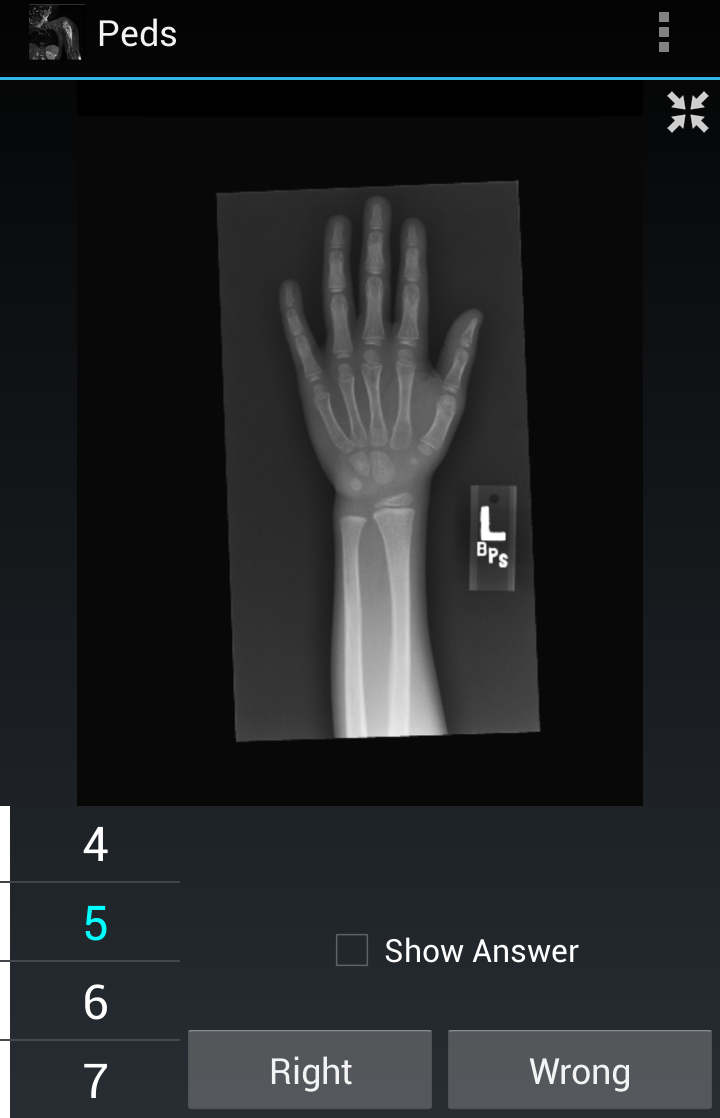 Radiology Flashcards: Peds Screen 2
