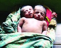 two-headed bangelandeshi boy Kiron