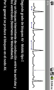 Electrocardiograma ECG Tipos(圖5)-速報App