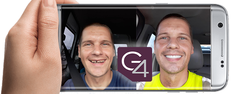 G4 Dental Implants