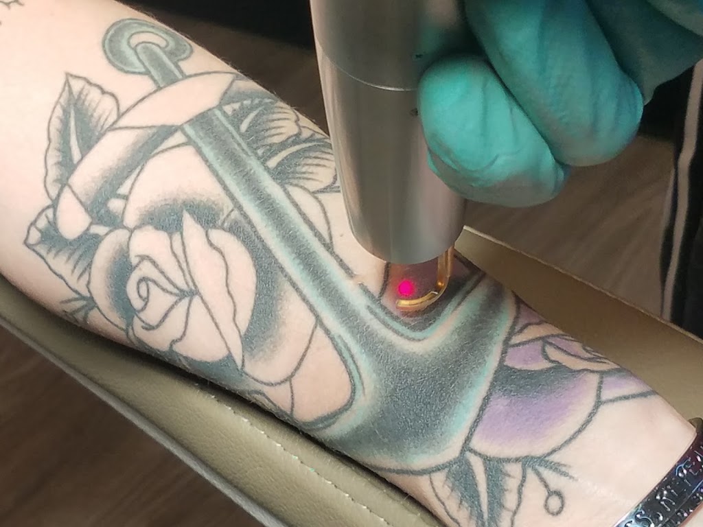 Vegas Laser Tattoo Removal
