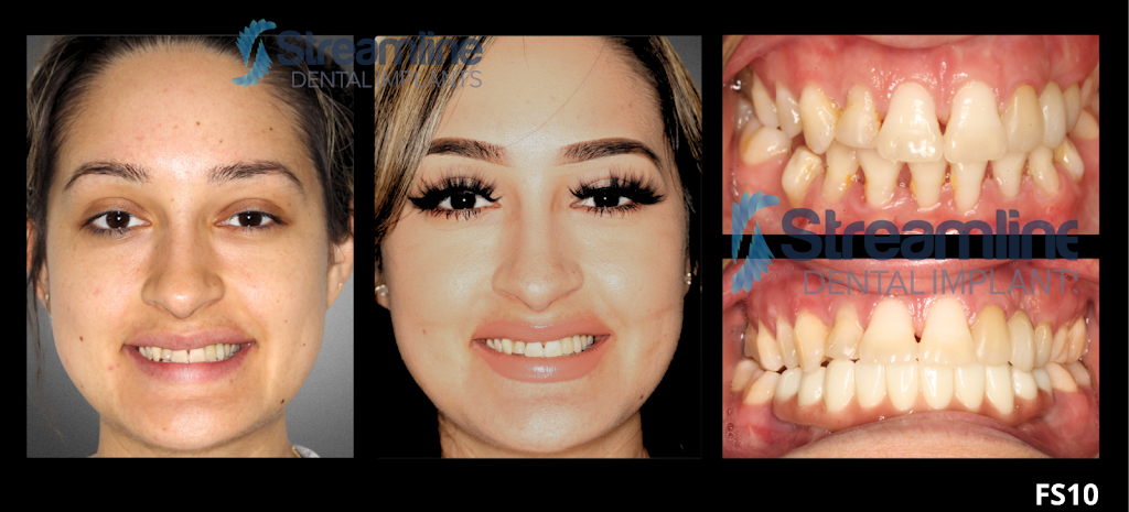  Braces Las Vegas