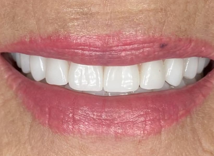  Digital dental implants
