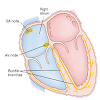 Cardiac Arrhythmia & Treatment