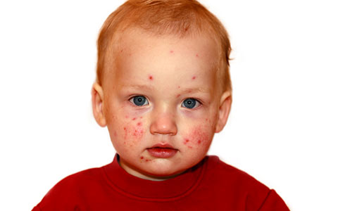 Paediatric Rashes - CPD Course For Nurses (10+ CPD Hours ...
