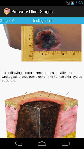 【免費健康App】Pressure Ulcer Guide-APP點子