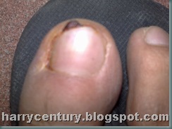 My toe