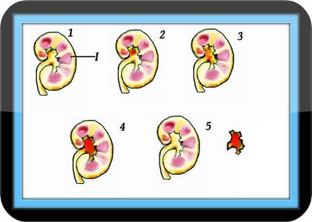 Kidney Failure - Guide