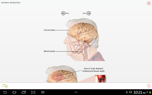 【免費醫療App】Brain Stroke-APP點子