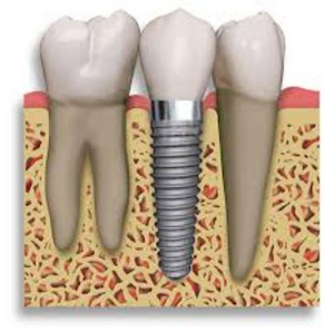 Dental Implant Billing Codes