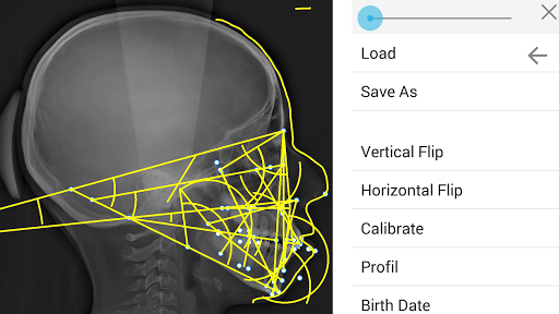 Cephalometric Analysis