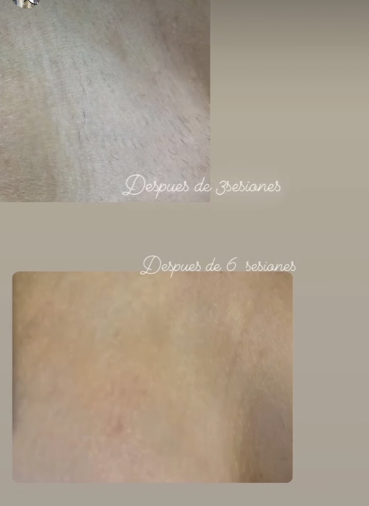 Depilacion Laser Diodo by Melania — Mas recientes