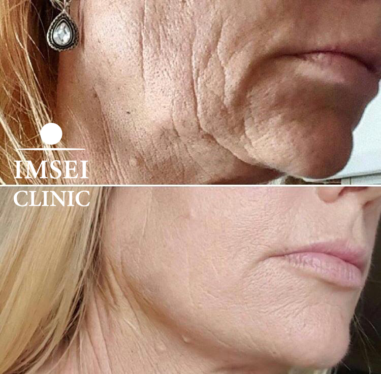 IMSEI CLINIC Doctor San Agustin -Aesthetic and Regenerative Medicine, Endolifting ,Lipolaser,Hialuronic ,Botox ,mesoterapia