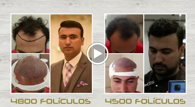Peluqueria Actoryno | Injerto Capilar Turquia — Del propietario