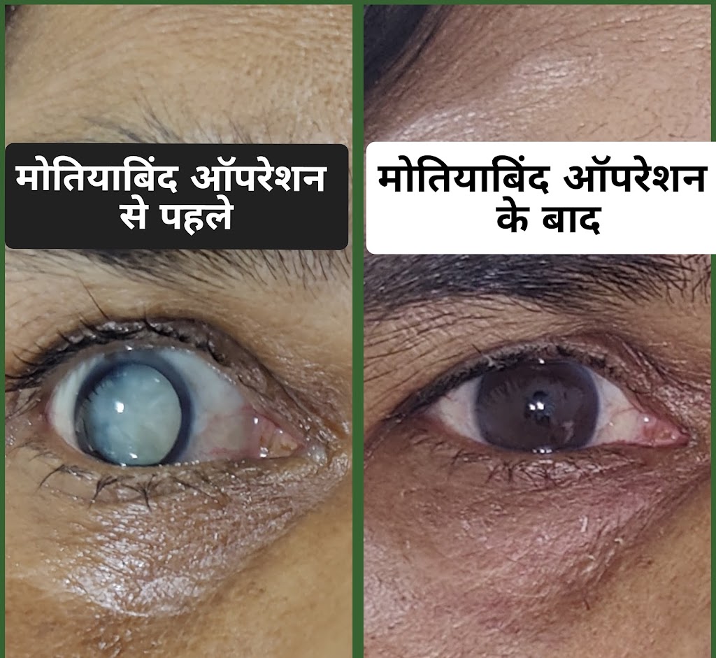 Eyeshine Eye Hospital Best Eye Hospital In Patna