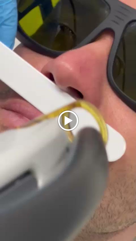 Suly Ruiz Laser Alejandrita — Videos