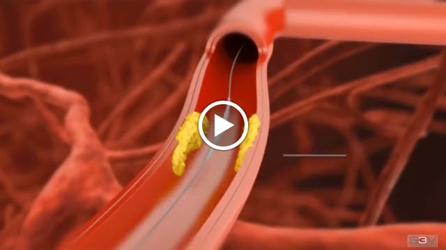 Dr. Kriti Health Care Best Neurologist Cardiologist In Hyderabad Heart Neurology Clinic In Kompally Suchitra