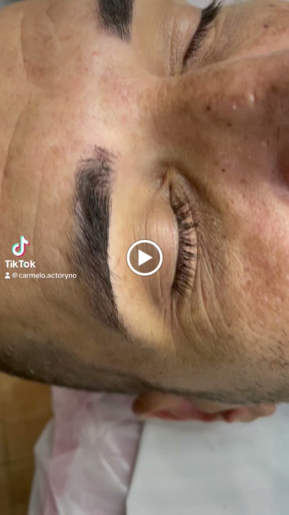 Peluqueria Actoryno | Injerto Capilar Turquia — Peinado