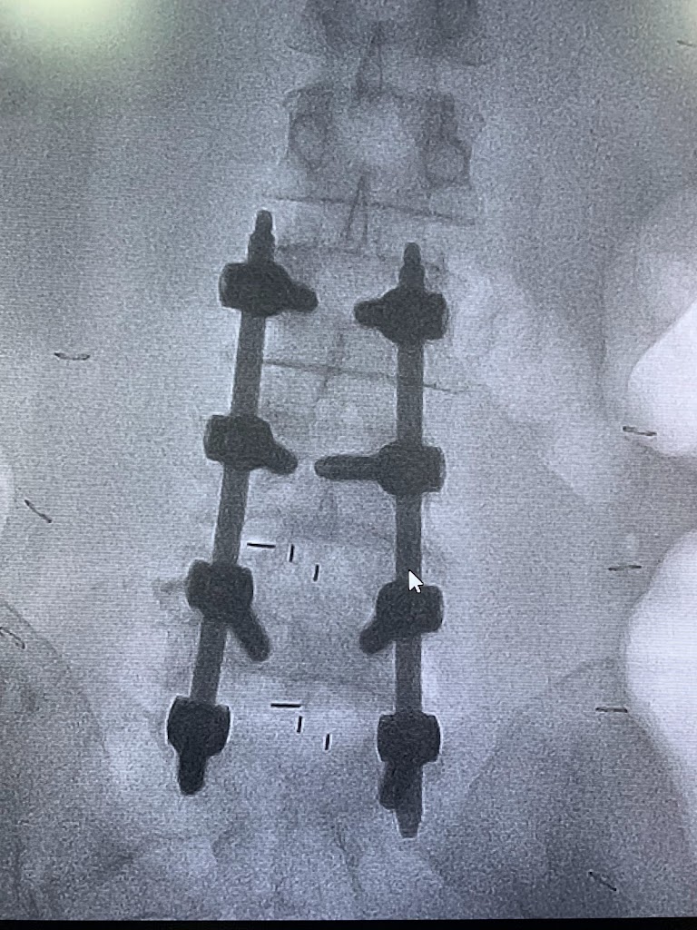 Dr. Dr Rao Dr Mohana Rao Patibandla Keyhole Neurosurgeon And Spine Surgeon