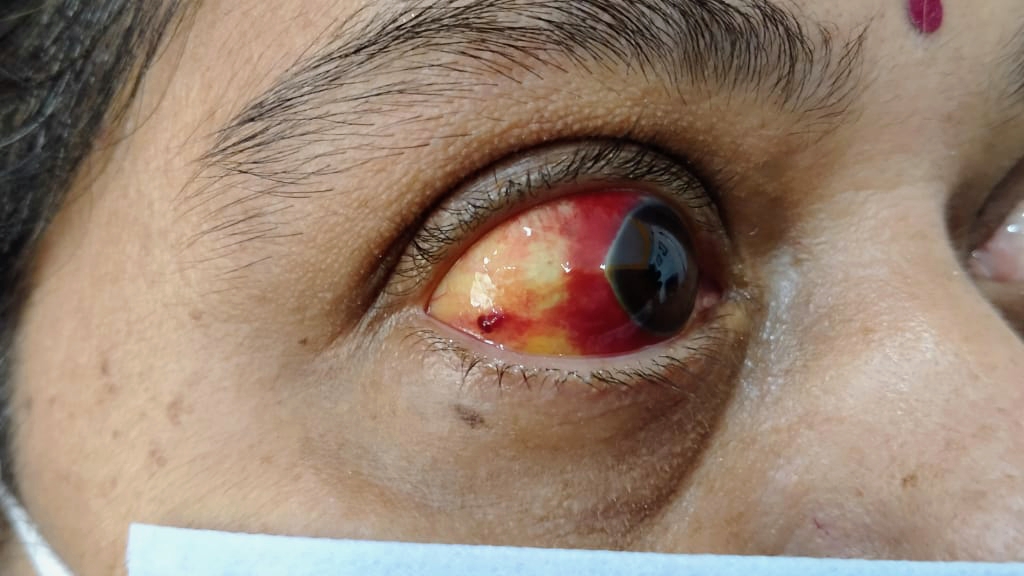 Dr Vijay Pratap Singh Mbbs Ms Ophthalmology