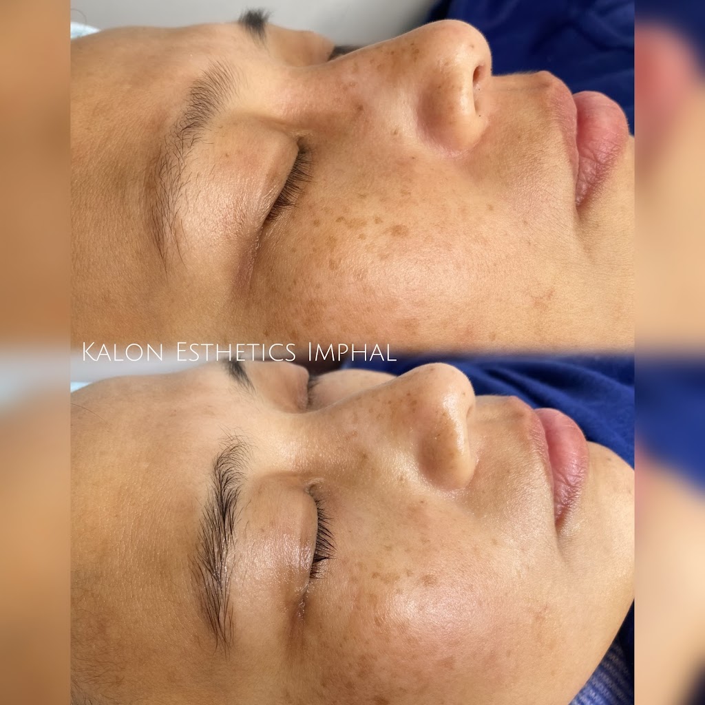 Kalon Esthetics Imphal