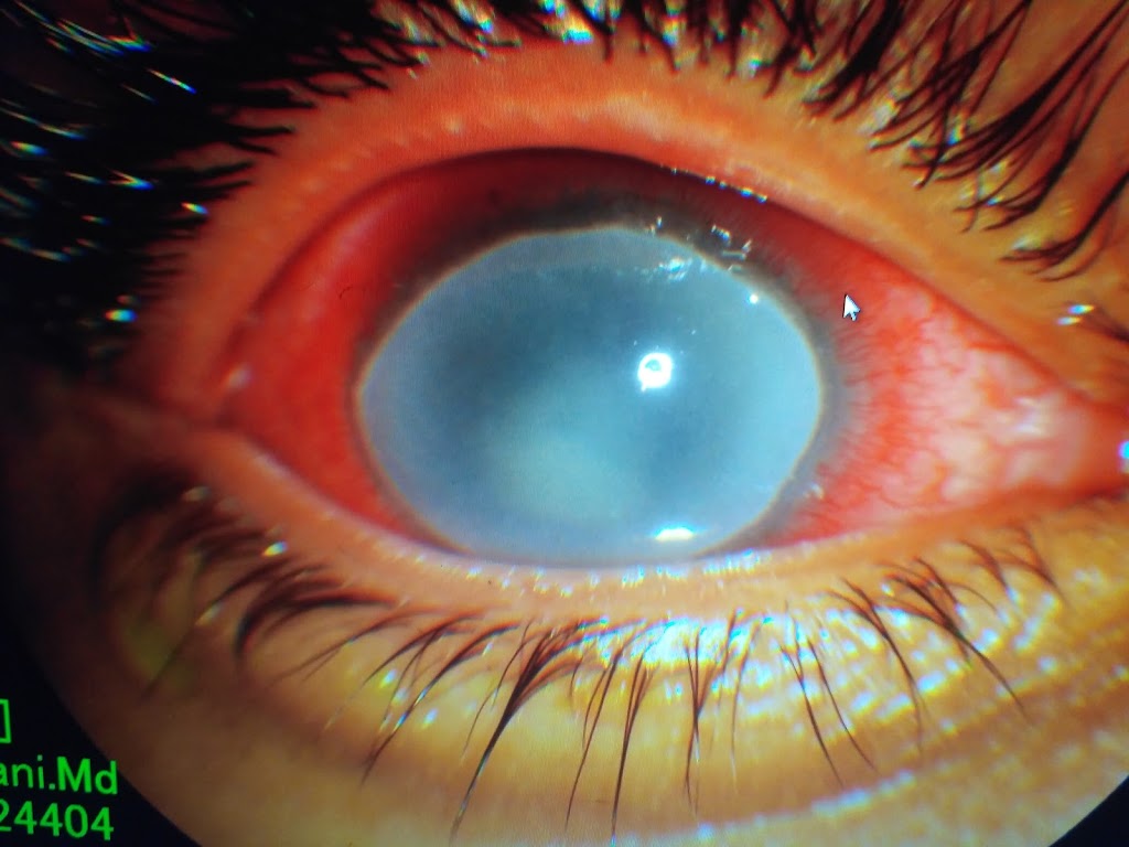Dr Sunny Manwani Consultant Vitreoretina Consultant Ophthalmologist