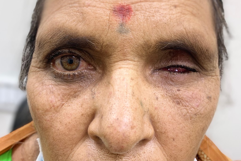 Artificial Eye Clinic India