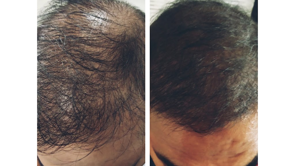 Growth Glow Hair Transplant Center Skin Aesthetic Laser Center In Nandurbar
