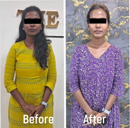 The Golden Gem Cosmetic Clinic Skin Clinic In Alandur Hair Transplant Skin Whitening Laser Hair Reduction