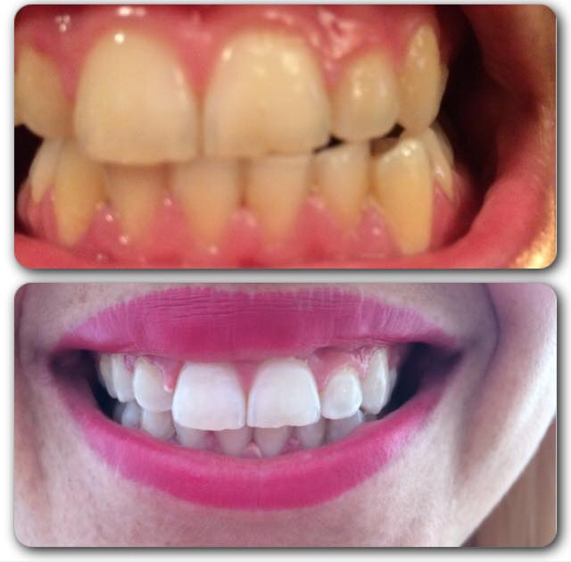 Hollywood Smile Tenerife - Teeth Whitening — Del propietario