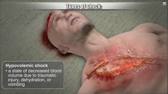 How to get Medrills: Shock 1.6 mod apk for bluestacks