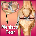 Meniscal Tear logo
