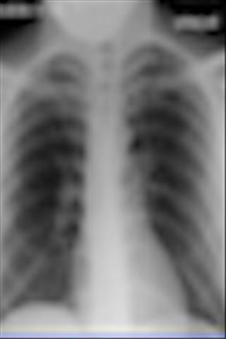 Pulmonary Board Questions