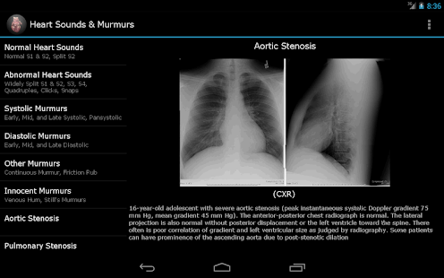 Heart Sounds Murmurs